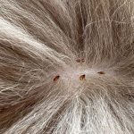 Can You Feel Fleas Crawling In Your Hair Causes & How To Treat